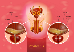 prostatiit